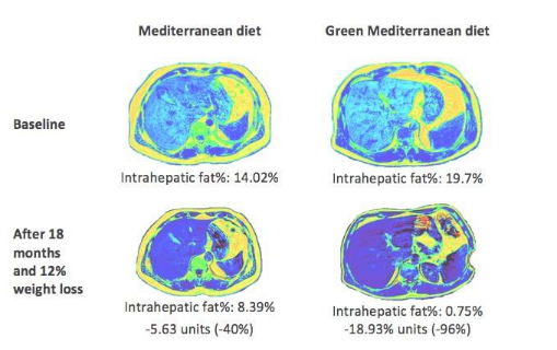 綠色地中海飲食可將非酒精性脂肪肝的疾病減少一半