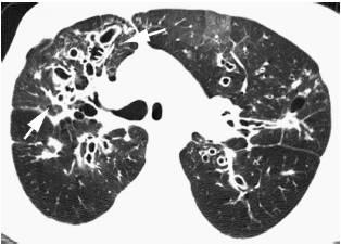 科學(xué)家們發(fā)現(xiàn)了一種新方法 可以治療囊性纖維化