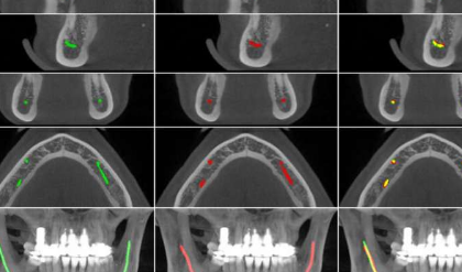 人工智能使牙醫(yī)的工作更加輕松 新模型有助于對下頜管進行定位