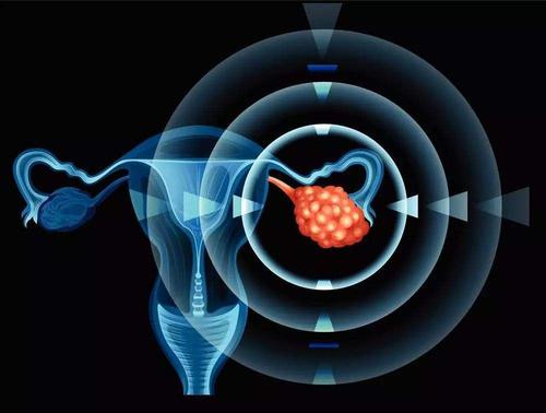 新研究發(fā)現(xiàn)新型免疫療法阻礙卵巢癌擴(kuò)散