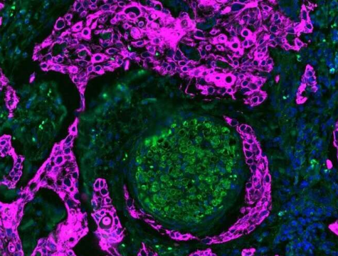 研究人員觀察神經(jīng)和腫瘤細(xì)胞之間的空間 以確定最具侵襲性的口腔癌
