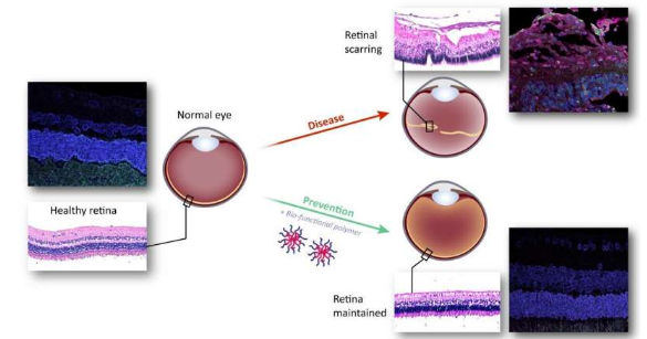 一種使用獨特熱凝膠的新型療法可預防視網(wǎng)膜疤痕