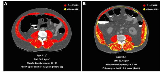 肌肉脂肪與更高的死亡風(fēng)險(xiǎn)有關(guān)