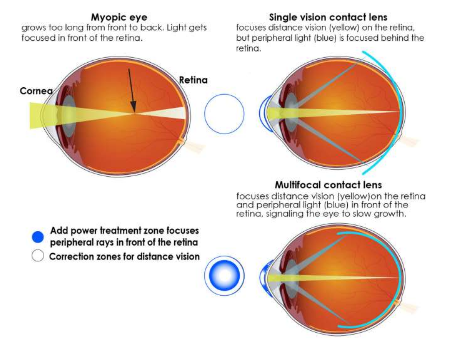 多焦點隱形眼鏡可減緩兒童近視加深