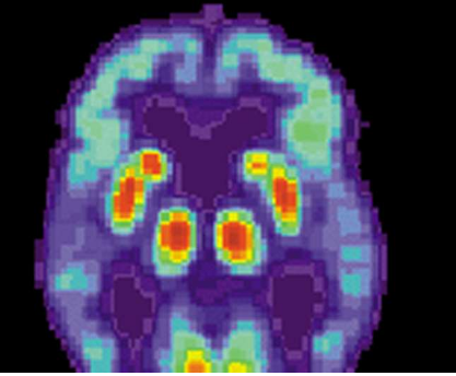 人工智能工具有望更快 更準確地診斷阿爾茨海默病