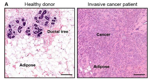 健康乳腺脂肪細(xì)胞對(duì)抗乳腺癌的力量