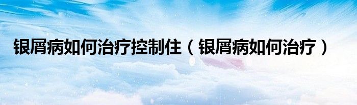 銀屑病如何治療控制?。ㄣy屑病如何治療）