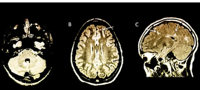 研究人員在癥狀出現(xiàn)之前就識(shí)別出患MS的高風(fēng)險(xiǎn)兒童
